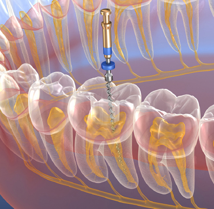 endodonzia