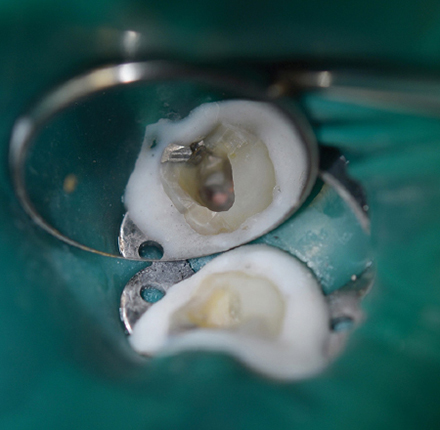 endodonzia